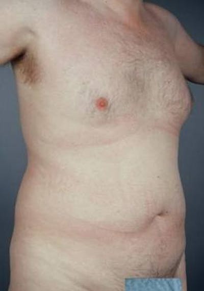 360 Liposuction Before & After Gallery - Patient 249920 - Image 1
