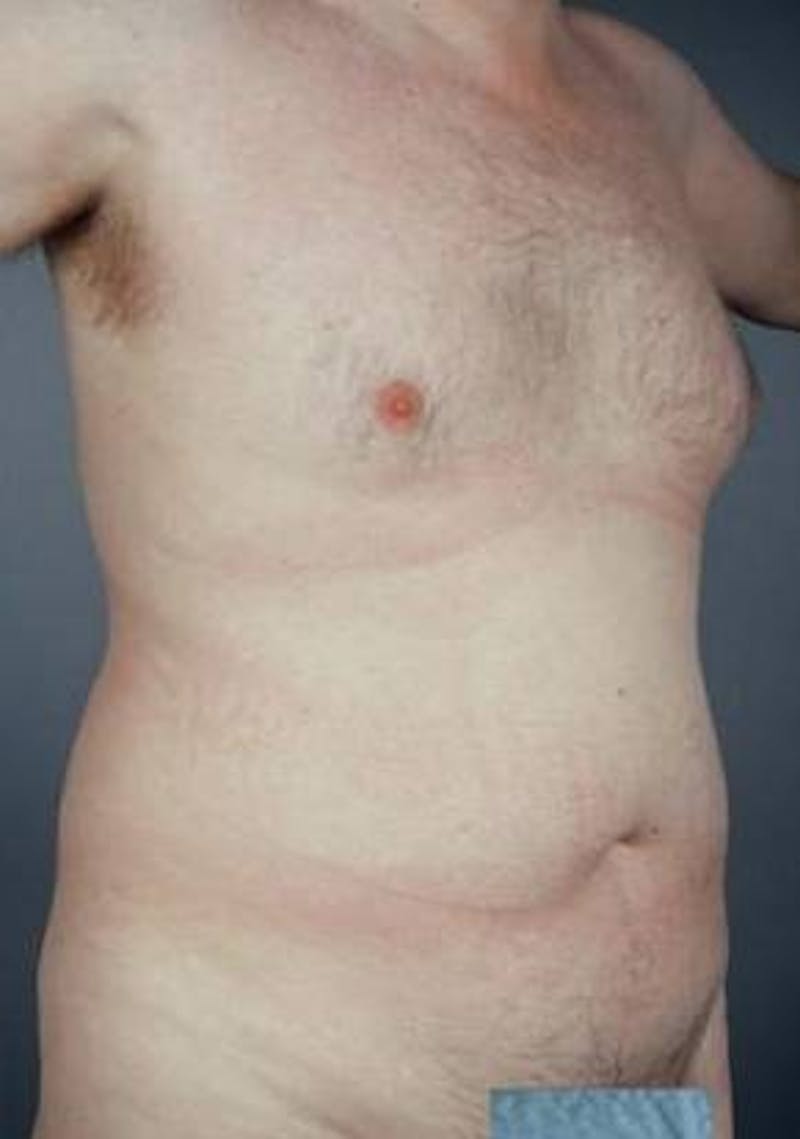 360 Liposuction Before & After Gallery - Patient 249920 - Image 1