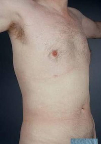 360 Liposuction Before & After Gallery - Patient 249920 - Image 2