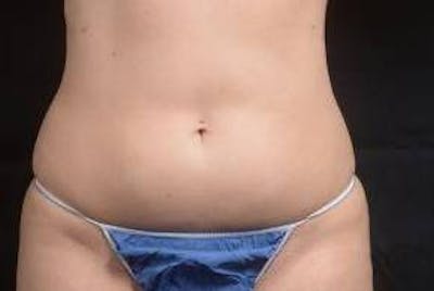360 Liposuction Before & After Gallery - Patient 292763 - Image 1