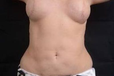 360 Liposuction Before & After Gallery - Patient 292763 - Image 2