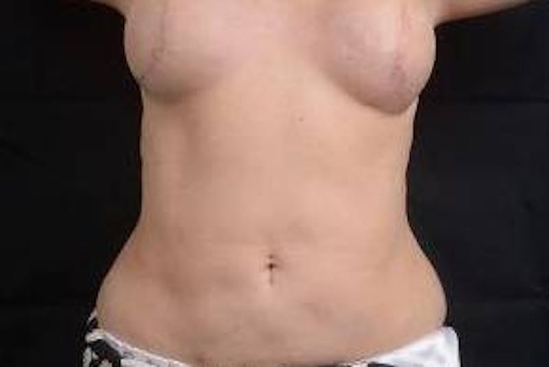 360 Liposuction Before & After Gallery - Patient 292763 - Image 2