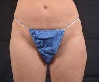 360 Liposuction Before & After Gallery - Patient 305550 - Image 2