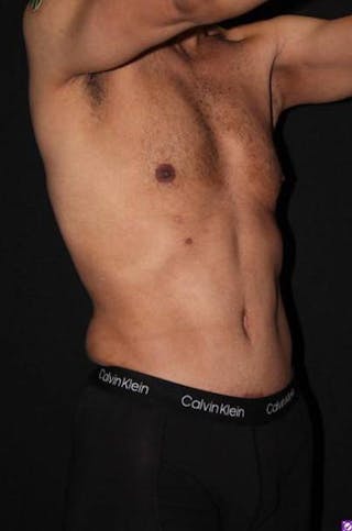 360 Liposuction Before & After Gallery - Patient 190711 - Image 6