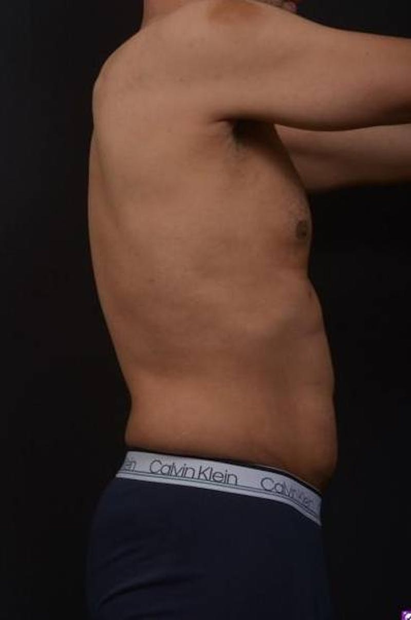 360 Liposuction Before & After Gallery - Patient 190711 - Image 7