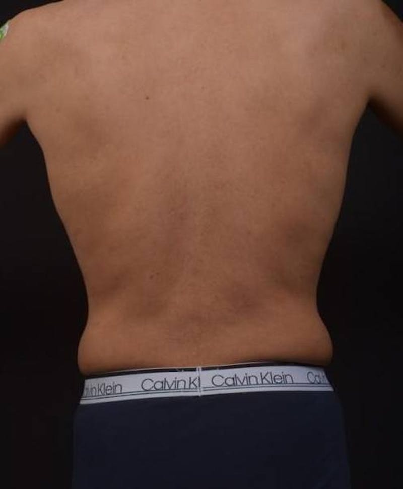 360 Liposuction Before & After Gallery - Patient 190711 - Image 9