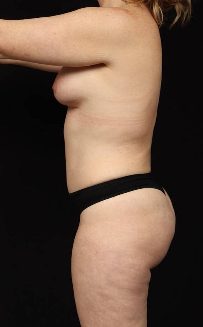 360 Liposuction Before & After Gallery - Patient 153794 - Image 6