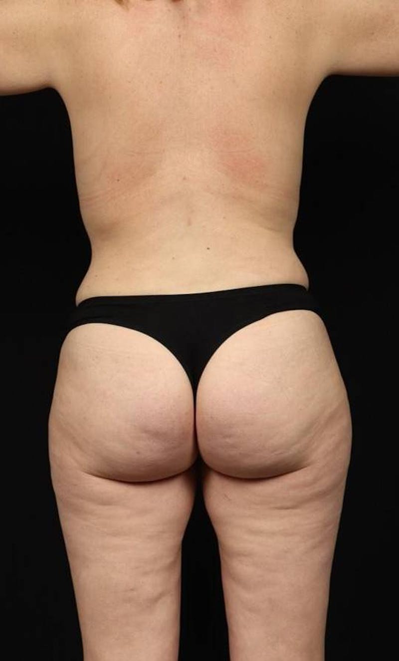 360 Liposuction Before & After Gallery - Patient 153794 - Image 8