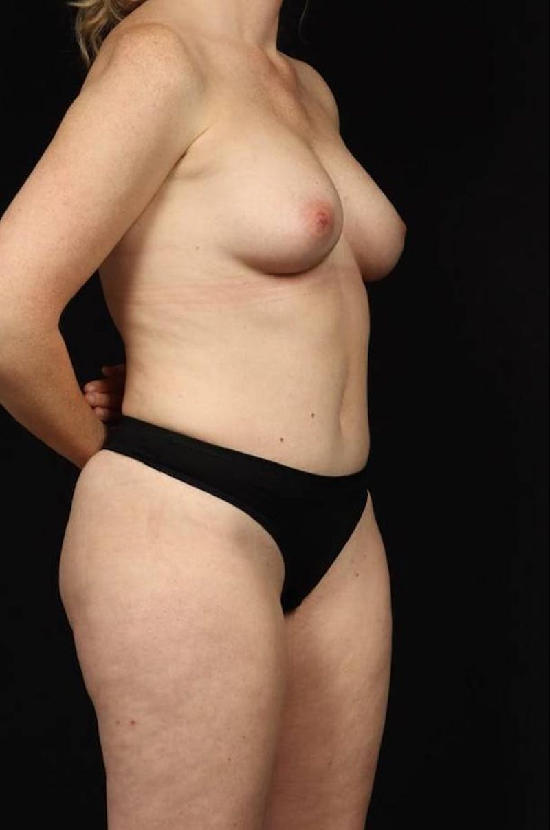 360 Liposuction Before & After Gallery - Patient 153794 - Image 10