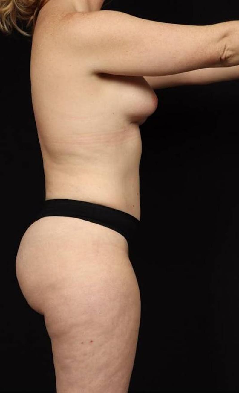360 Liposuction Before & After Gallery - Patient 153794 - Image 12