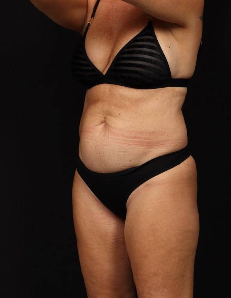360 Liposuction Before & After Gallery - Patient 513562 - Image 3