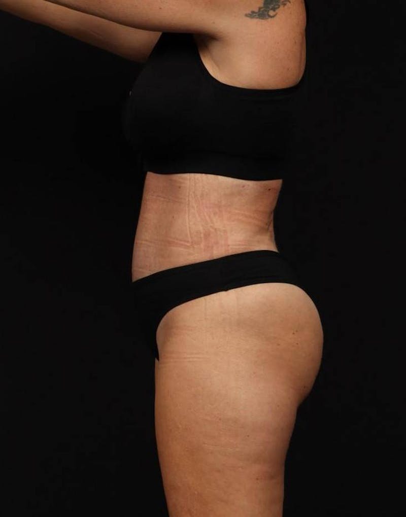 360 Liposuction Before & After Gallery - Patient 513562 - Image 6