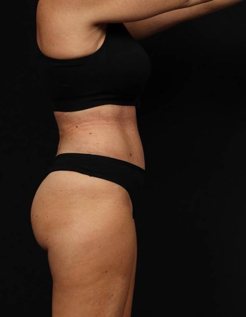 360 Liposuction Before & After Gallery - Patient 513562 - Image 10