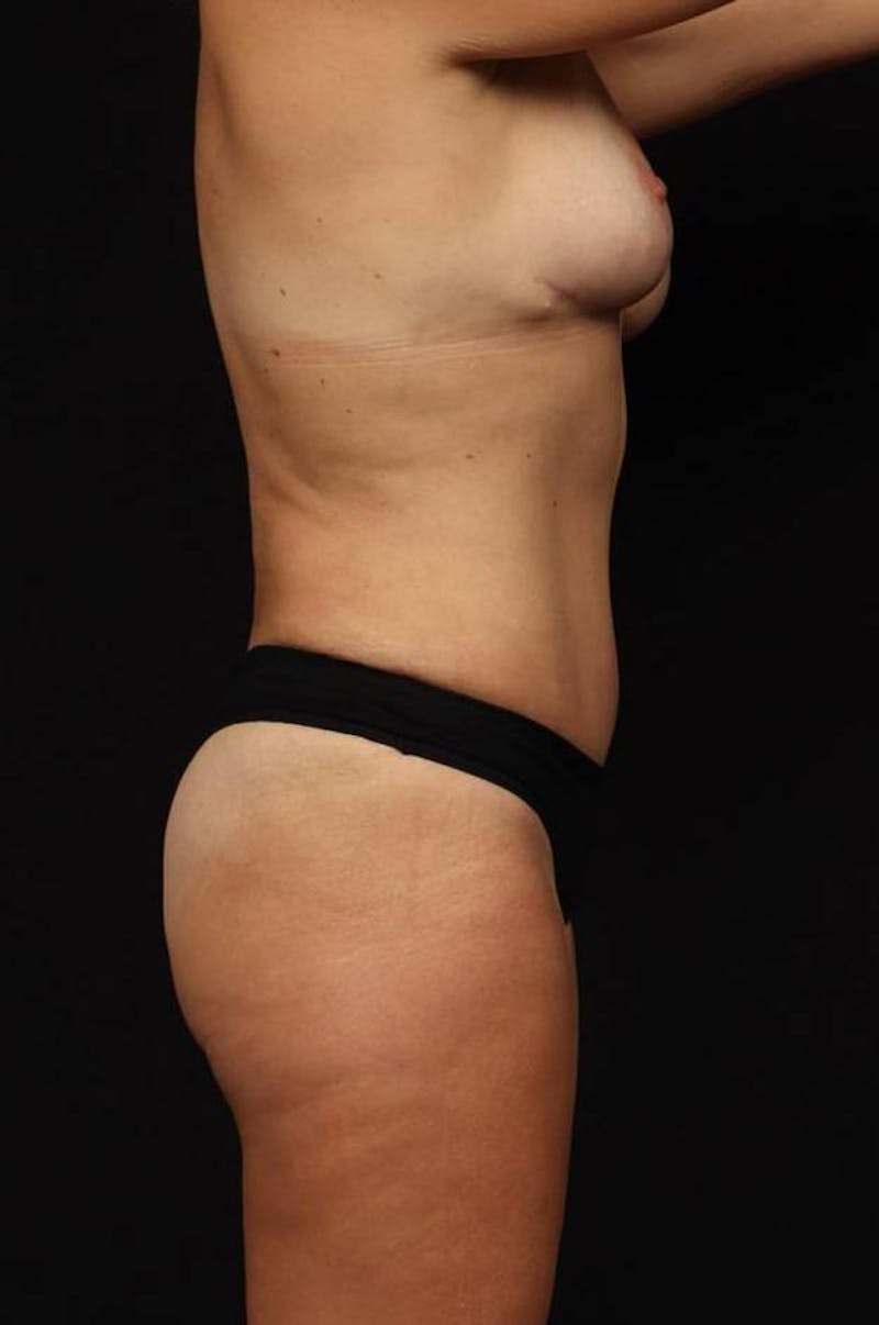 360 Liposuction Before & After Gallery - Patient 143944 - Image 10