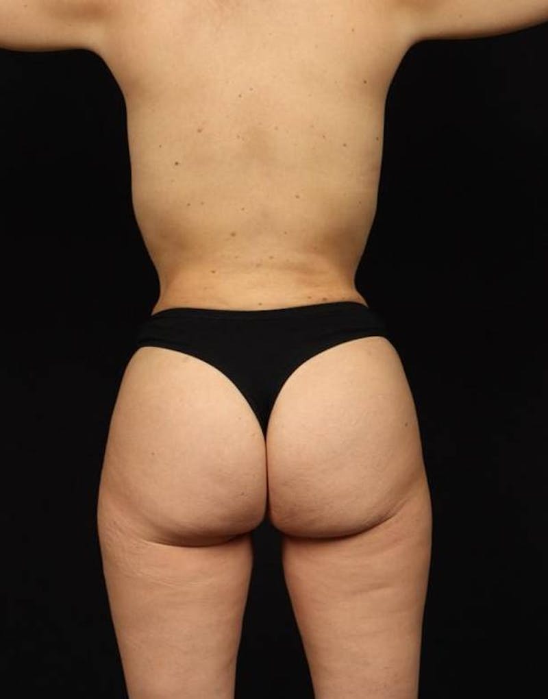 360 Liposuction Before & After Gallery - Patient 499222 - Image 4
