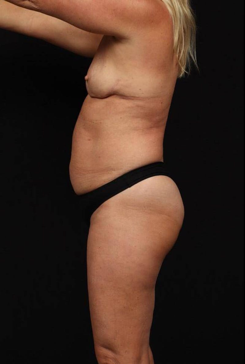360 Liposuction Before & After Gallery - Patient 245362 - Image 5