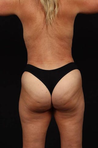 360 Liposuction Before & After Gallery - Patient 245362 - Image 12