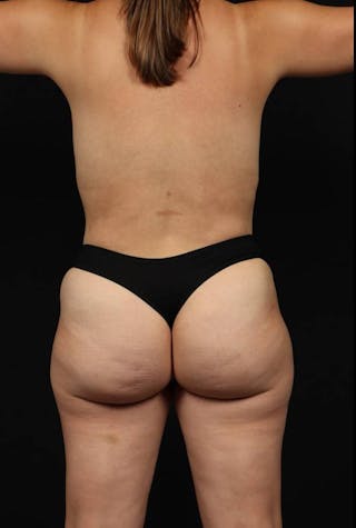 360 Liposuction Before & After Gallery - Patient 168469 - Image 12