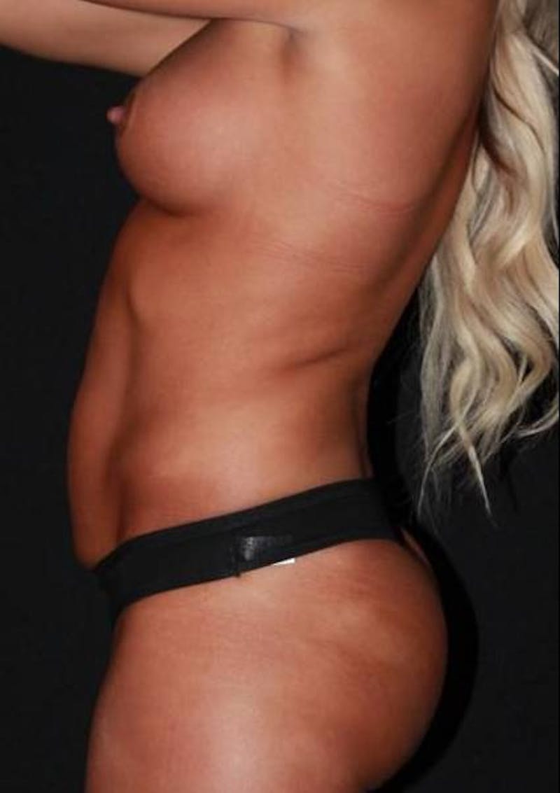 360 Liposuction Before & After Gallery - Patient 174936 - Image 5