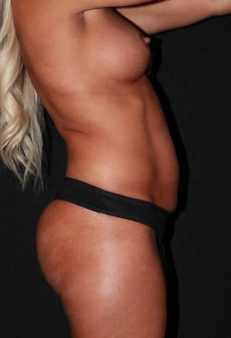 360 Liposuction Before & After Gallery - Patient 174936 - Image 9