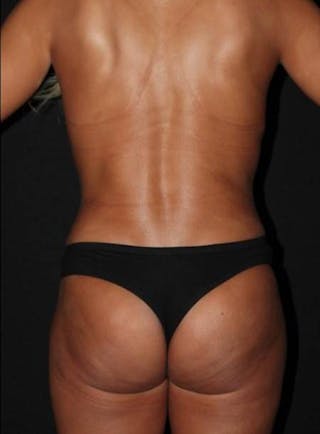 360 Liposuction Before & After Gallery - Patient 174936 - Image 12