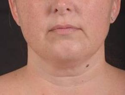 360 Liposuction Before & After Gallery - Patient 289179 - Image 1
