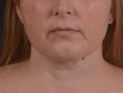 360 Liposuction Before & After Gallery - Patient 289179 - Image 2