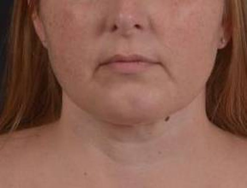 360 Liposuction Before & After Gallery - Patient 289179 - Image 2
