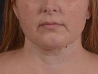 360 Liposuction Before & After Gallery - Patient 289179 - Image 2