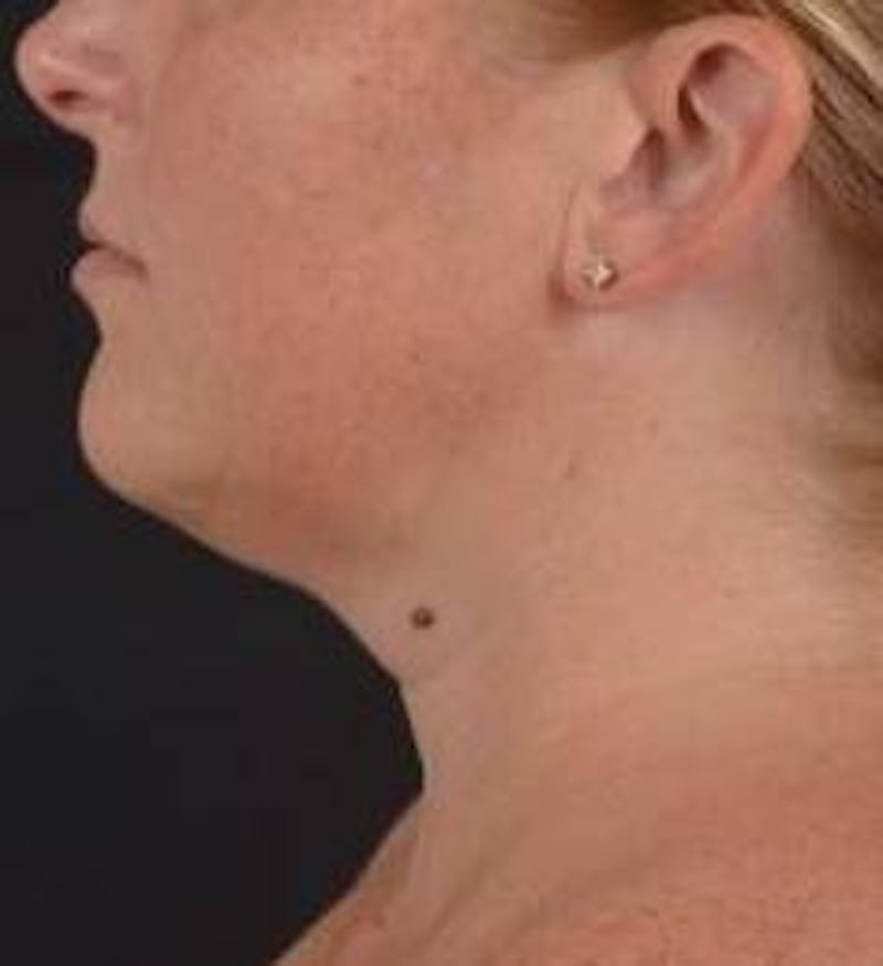 360 Liposuction Before & After Gallery - Patient 289179 - Image 3