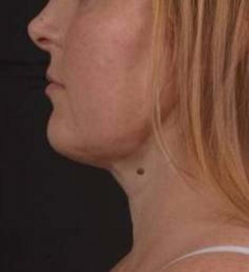 360 Liposuction Before & After Gallery - Patient 289179 - Image 4