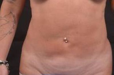 360 Liposuction Before & After Gallery - Patient 124298 - Image 1