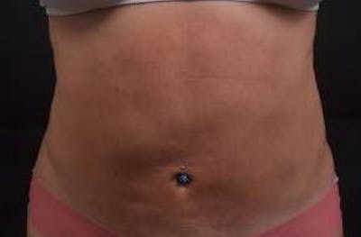 360 Liposuction Before & After Gallery - Patient 124298 - Image 2