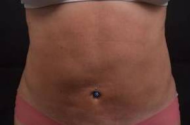 360 Liposuction Before & After Gallery - Patient 124298 - Image 2