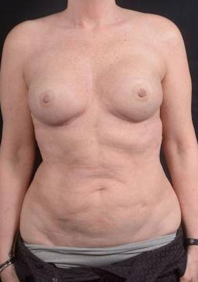 360 Liposuction Before & After Gallery - Patient 225333 - Image 1