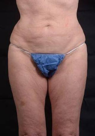 360 Liposuction Before & After Gallery - Patient 225333 - Image 2