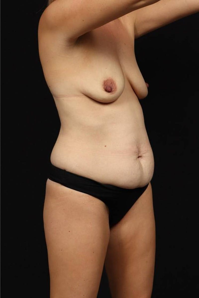 360 Liposuction Before & After Gallery - Patient 315745 - Image 7
