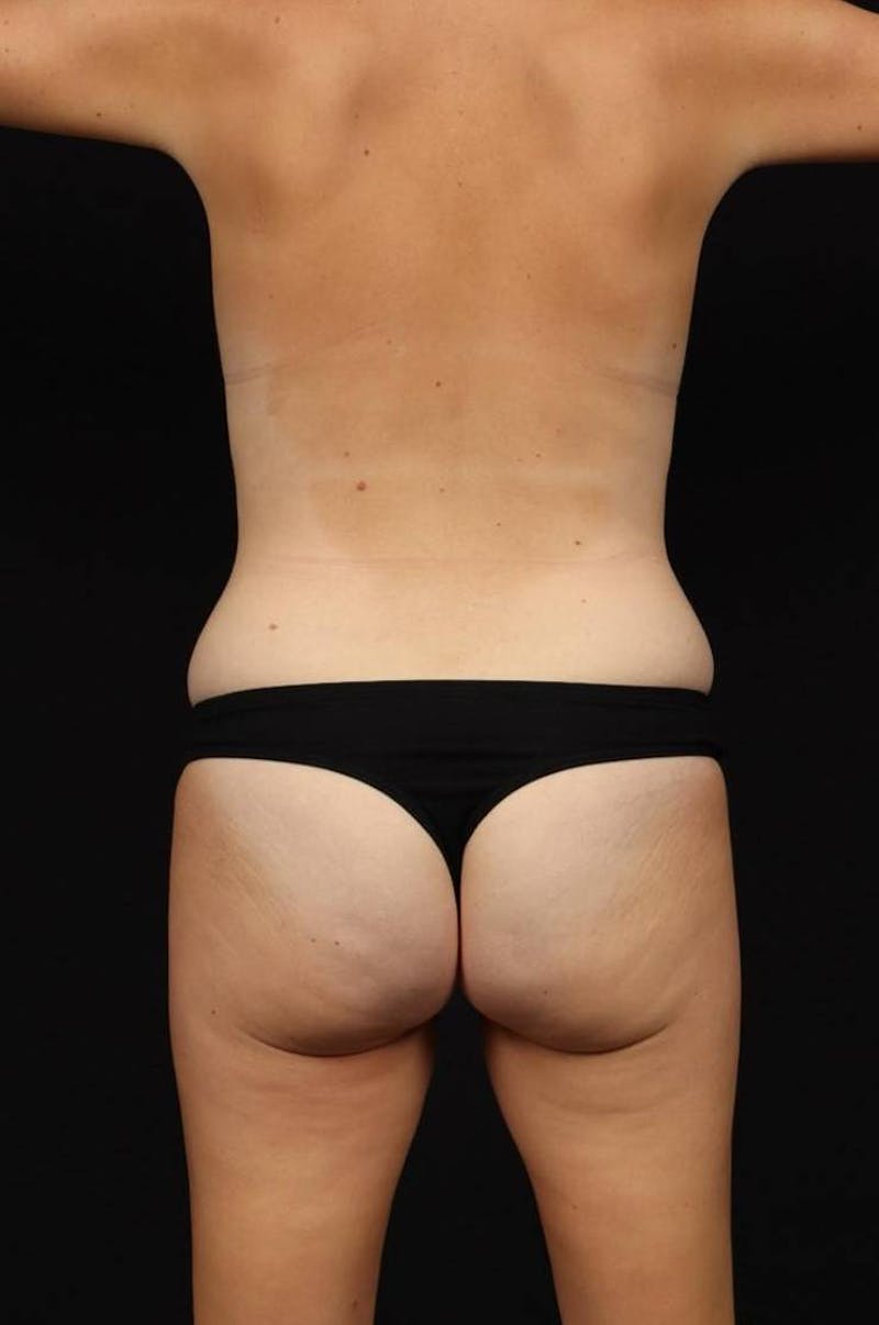 360 Liposuction Before & After Gallery - Patient 315745 - Image 11
