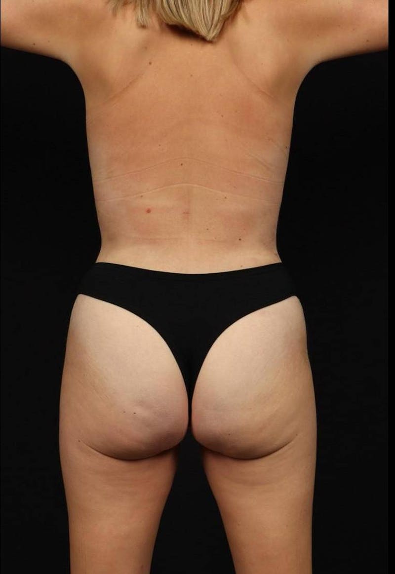 360 Liposuction Before & After Gallery - Patient 315745 - Image 12