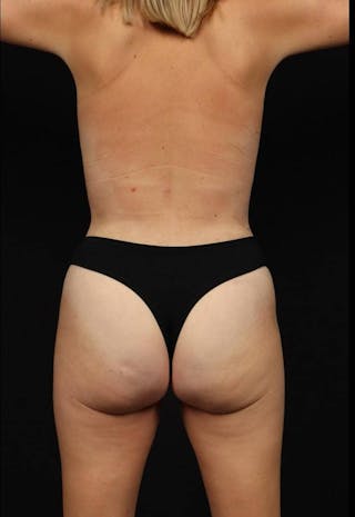 360 Liposuction Before & After Gallery - Patient 315745 - Image 12