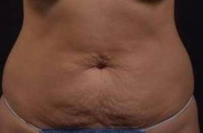 Abdominoplasty Before & After Gallery - Patient 219618 - Image 1