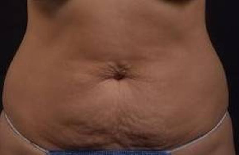 Abdominoplasty Before & After Gallery - Patient 219618 - Image 1