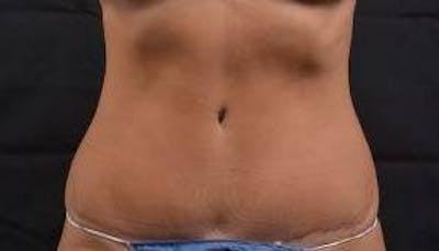 Abdominoplasty Before & After Gallery - Patient 219618 - Image 2
