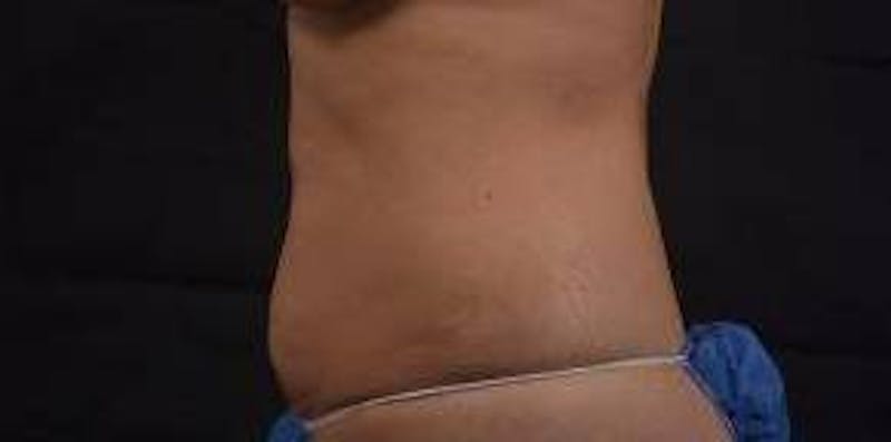 Abdominoplasty Before & After Gallery - Patient 219618 - Image 3
