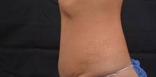 Abdominoplasty Before & After Gallery - Patient 219618 - Image 4