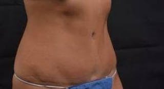 Abdominoplasty Before & After Gallery - Patient 219618 - Image 10