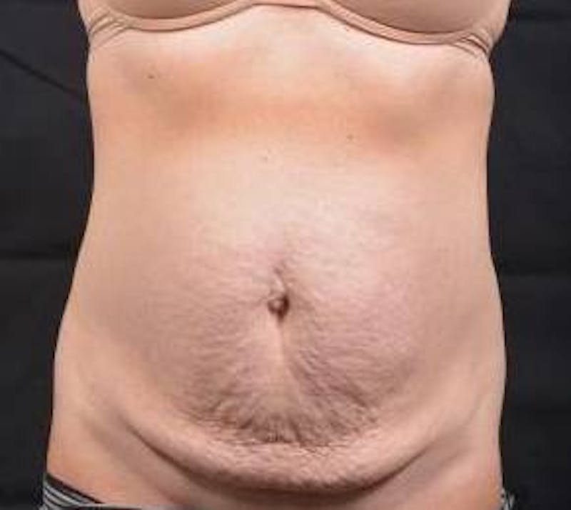 Abdominoplasty Before & After Gallery - Patient 196513 - Image 1
