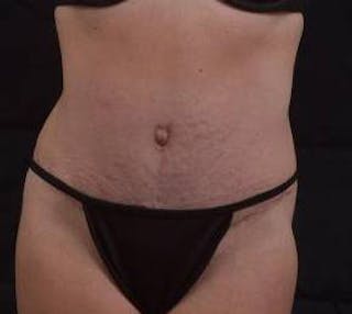 Abdominoplasty Before & After Gallery - Patient 196513 - Image 2