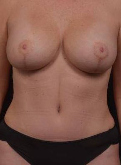Abdominoplasty Before & After Gallery - Patient 410231 - Image 2