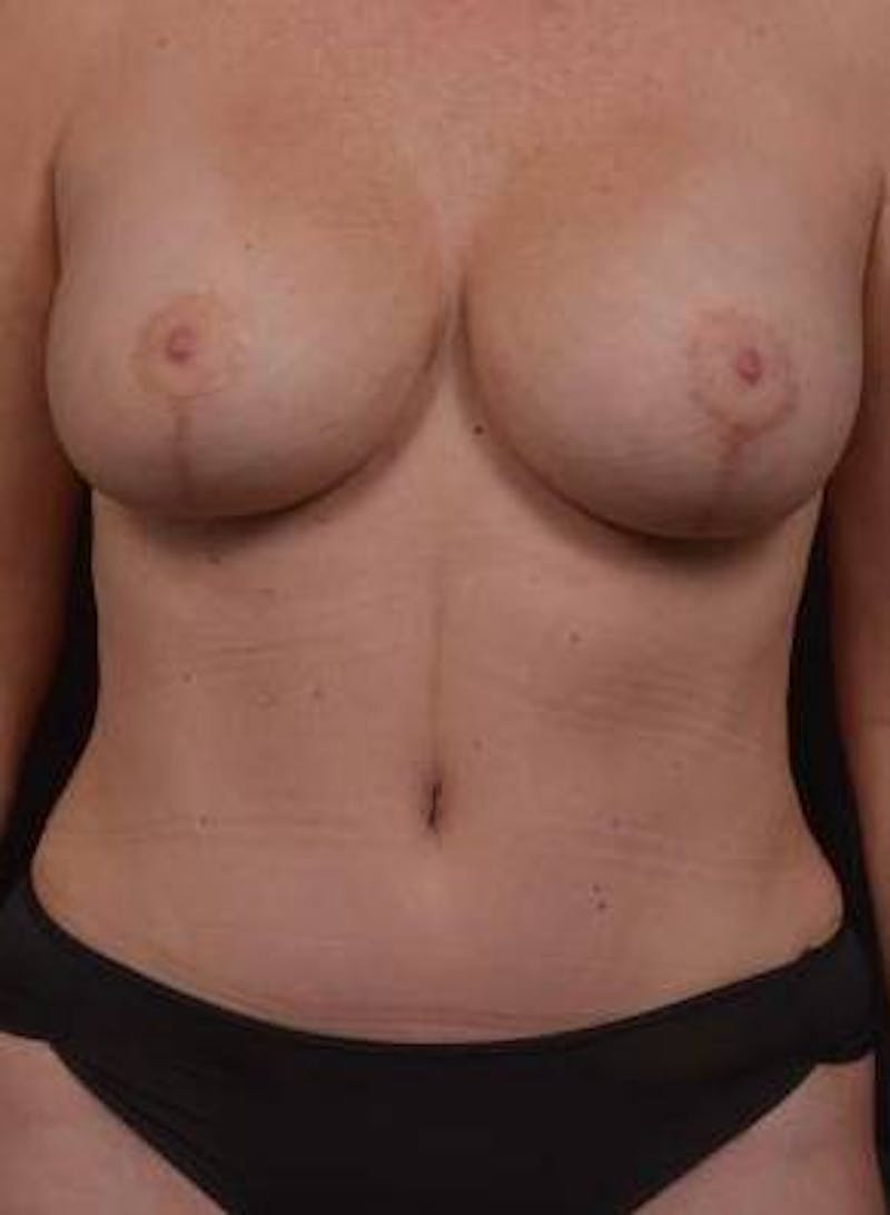 Abdominoplasty Before & After Gallery - Patient 410231 - Image 2